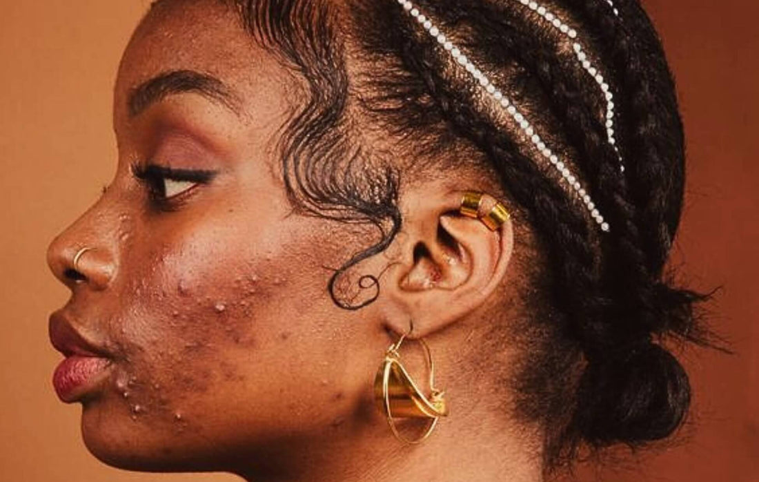 eube DESPADRONIZE-SE CUIDANDO DA PELE NEGRA OLEOSA E PROPENSA A ACNE