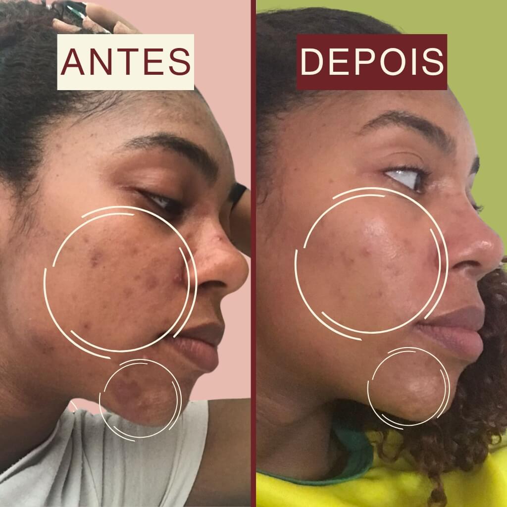 ester_uniformizador_facial_avanzado_resultado_22_dias_eube_antes_depois_2